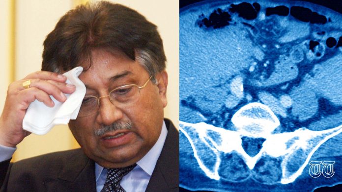 A combination photo is shown of former president General Pervez Musharraf and a CT scan of amyloidosis.