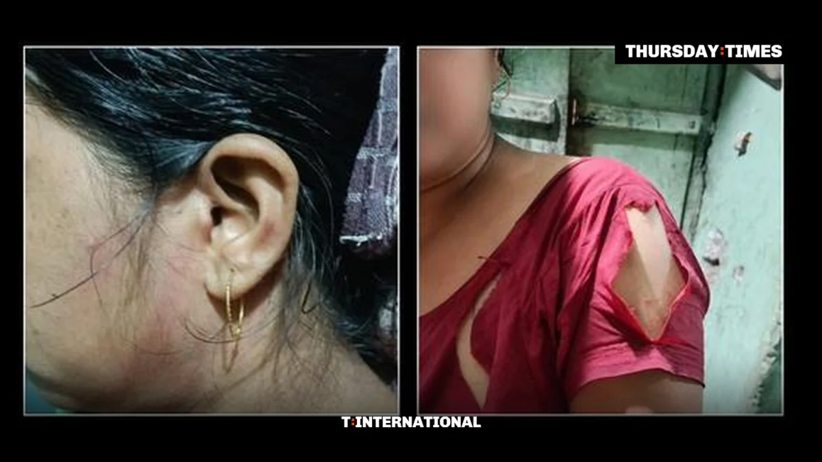 Injuries to one of the Christian women attacked in Paschim Medinipur district, West Bengal. — Photograph: Scroll India